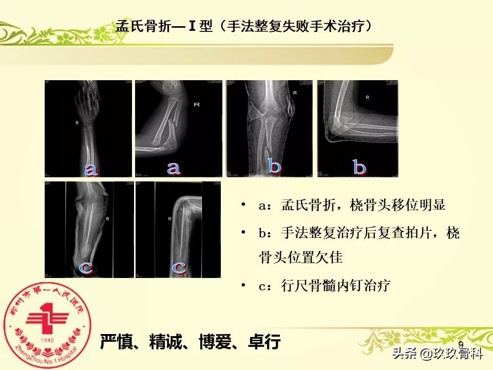孟氏骨折功能训练多久能恢复正常,孟氏骨折中医能治吗