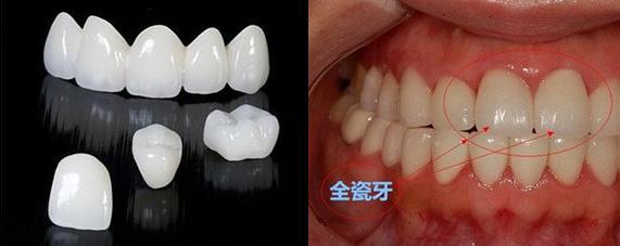 全瓷牙和烤瓷牙区别以及价格,烤瓷牙与全瓷牙有多大价格区别