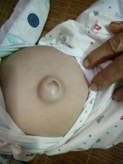 宝宝脐疝有什么症状,宝宝脐疝的症状及表现