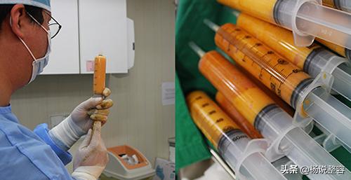 科普：自体脂肪面部填充有哪些优缺点、有哪些风险呢？