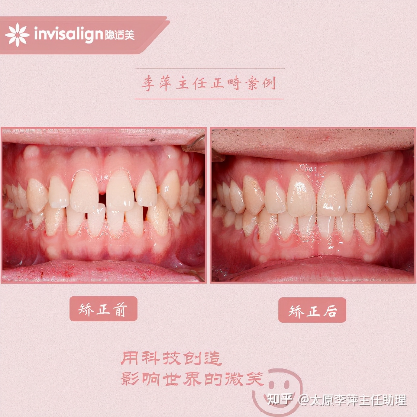 重度拥挤矫正牙齿适合隐形牙套吗,广州成人牙齿矫正推荐隐形牙套