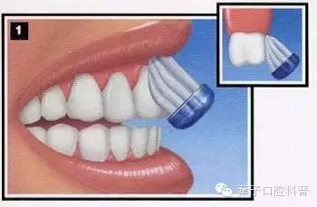 拉锯式刷牙可能造成牙齿缺损,暴力刷牙造成牙齿楔状缺损