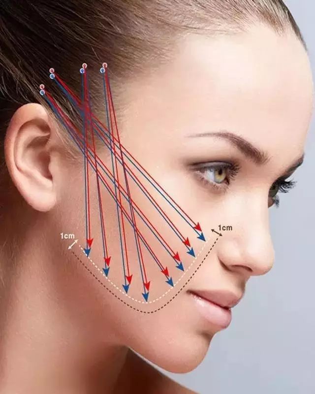 线雕第八天脸更大了,皮肤很松垮能做线雕吗