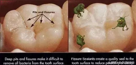 10个小孩7个都有蛀牙，别等孩子牙都烂完了才知道这个办法！