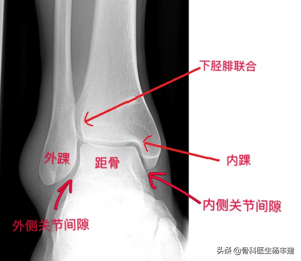 脚踝骨折做手术大概多少钱,右脚踝骨折做手术要多少小时