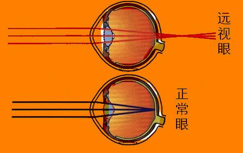 远视和老花的区别,怎么区别老花还是远视