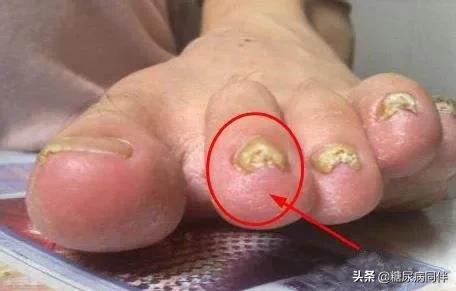 糖尿病足烂脚前有6个症状,糖尿病足早期症状如何治疗