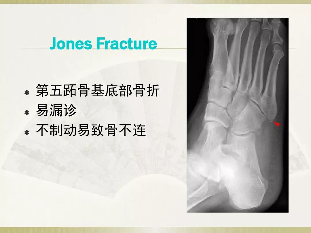 骨科x光片读片技巧,放射科骨科读片教程