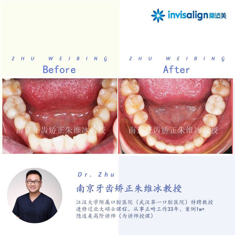 南京口腔医院矫正一颗牙齿多少钱,大医院为啥不建议做牙齿矫正