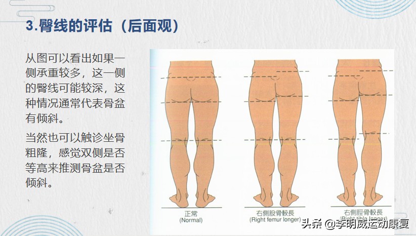 骨盆侧倾的治疗方法,骨盆侧倾最佳的矫正方法