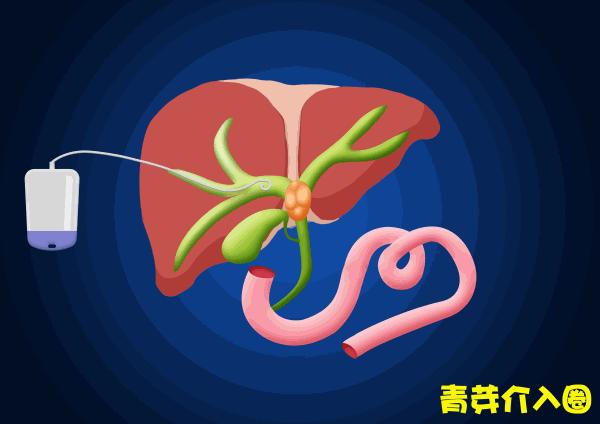 胆道阻塞眼睛发黄图片,胆管堵塞全身发黄中医治疗