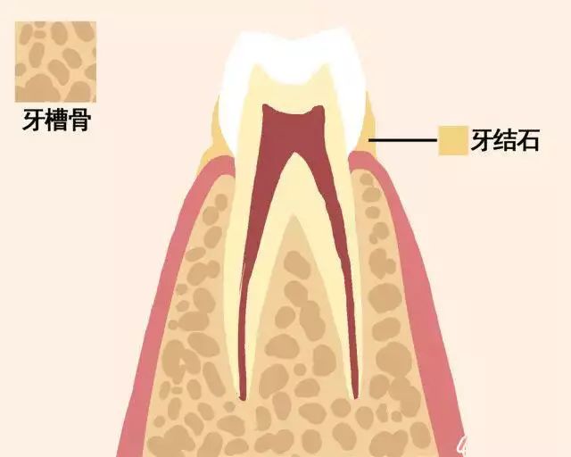 牙齿是怎么掉下来的图片,牙齿如何脱落动图