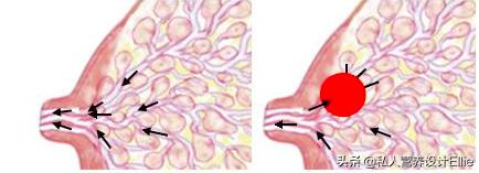 月子里堵奶发烧最快的解决方法,月子乳腺堵发烧
