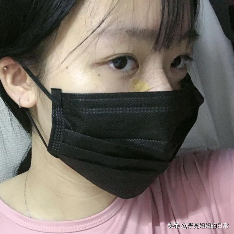 隆鼻改善蒜头鼻,蒜头鼻隆鼻一年后的真实感受