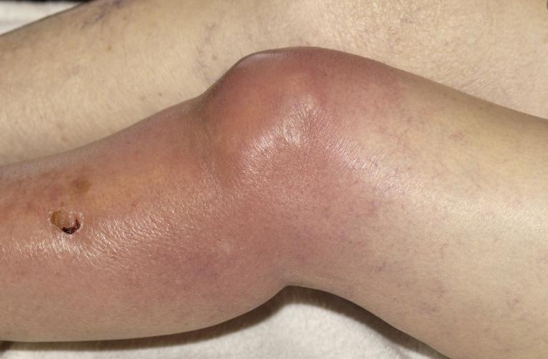 滑膜炎导致的膝盖积液用不用抽取,关节炎有积液属于滑膜炎类型吗