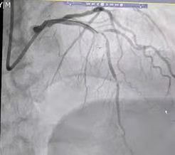 陕西冠脉介入手术,冠脉支架降价最新价格