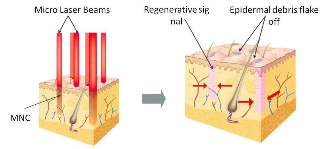 激光治疗仪开关,激光照射治疗禁忌