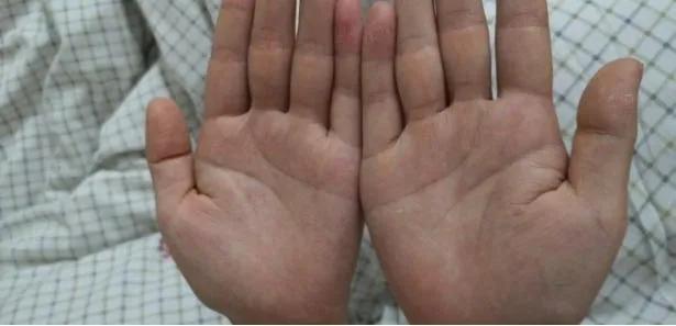 医院怎么确诊手汗症,广西手汗症治疗