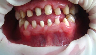 吴宣仪烤瓷牙怎么做,吴宣仪的整牙前