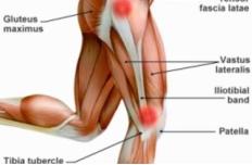 髂胫束摩擦综合征（膝外侧疼痛）跑步杀手，自我预防、康复的方法