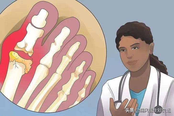 痛风和高血糖,痛风跟血糖高适合吃什么