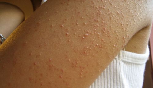 鸡皮疙瘩怎么拯救,治疗鸡皮肤最快的方法