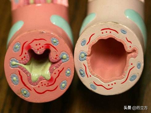 慢阻肺是什么?慢阻肺的危害,慢阻肺的治疗方法及如何预防