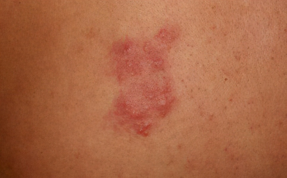 得了玫瑰糠疹用什么药物,玫瑰糠疹药物