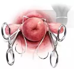 孕期宫颈环扎是怎么做,宫颈机能不全做环扎成功率有多高