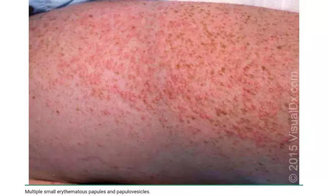 新生儿皮肤问题大全一览表,新生儿常见八大皮肤问题