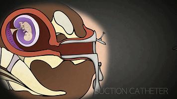 堕胎可怕吗,堕胎到底多可怕