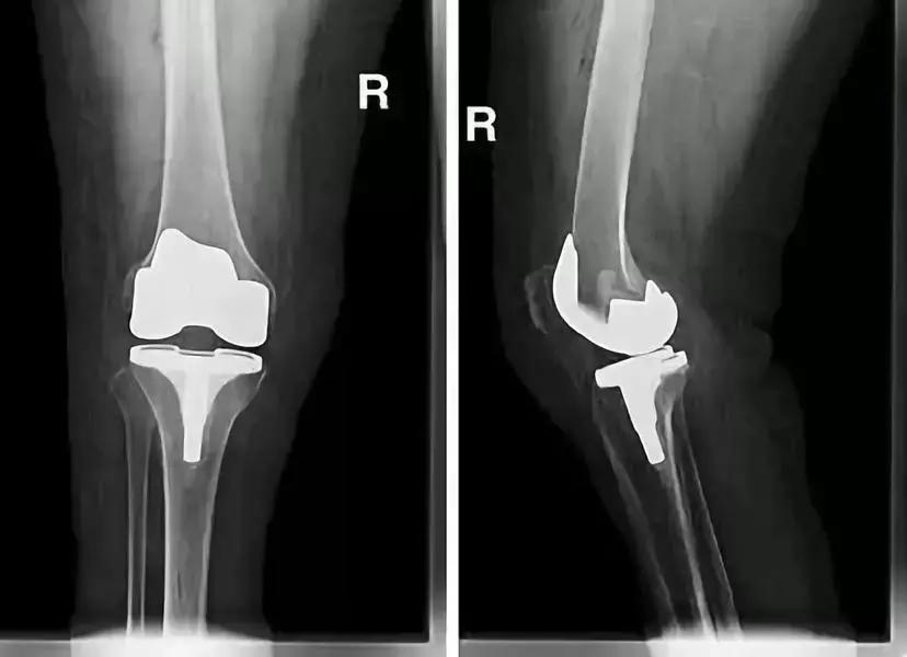 老年人膝关节疼痛蹲下不能站起,老年人膝关节伸不直加疼痛