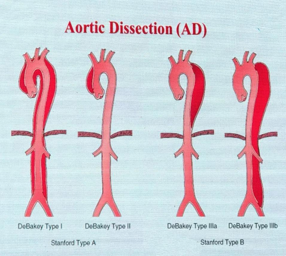 主动脉夹层最凶险的病,怎么判断凶险主动脉夹层