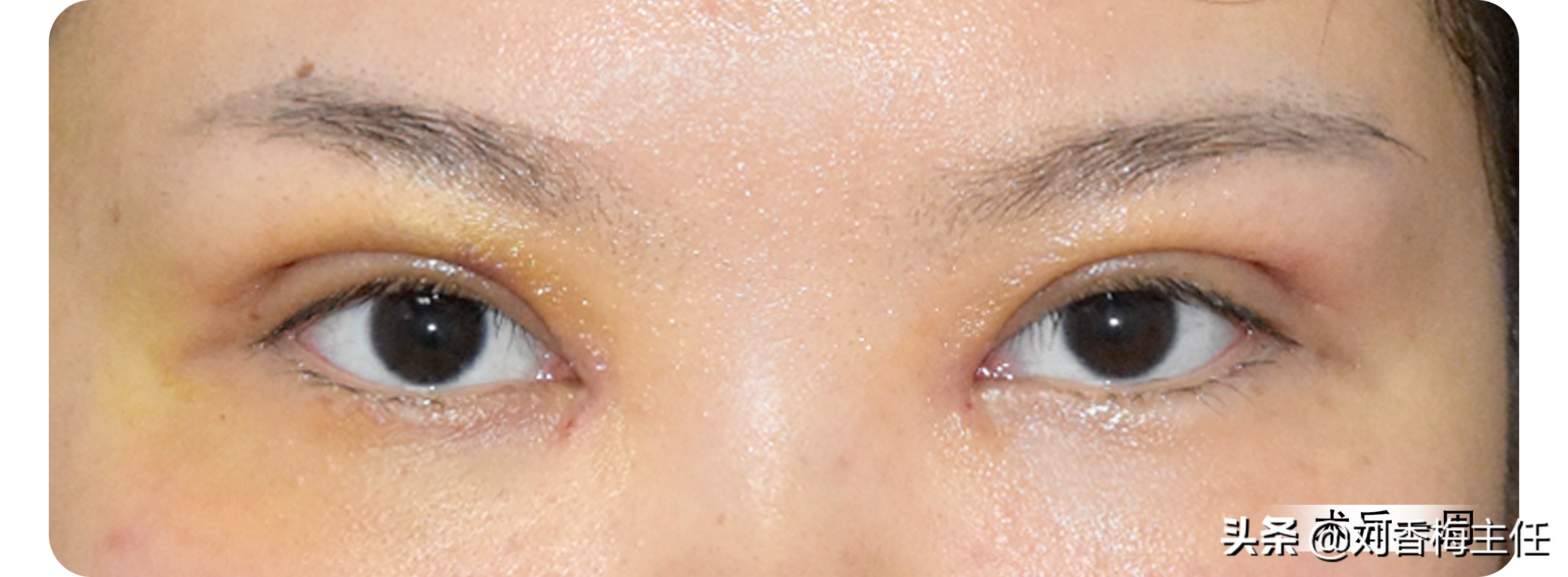 双眼皮恢复过程中不一样宽正常么,三点定位双眼皮恢复10天过程图