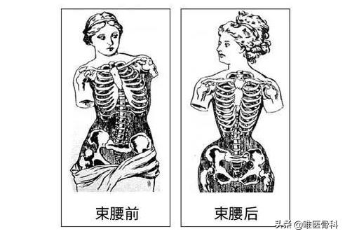 这要命的事千万别做！关于「束腰」你必须要知道的真相