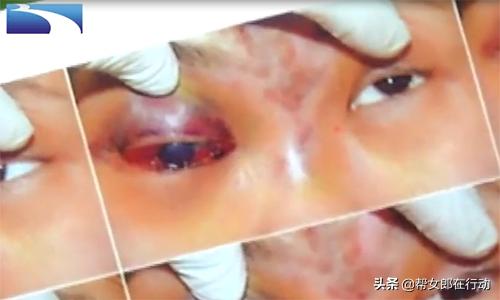 整容失败眼睛失明的案例,玻尿酸隆鼻手术失明