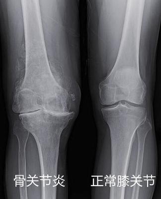 膝盖关节炎腿疼有什么好的方法吗,膝盖关节炎有骨刺怎么治疗