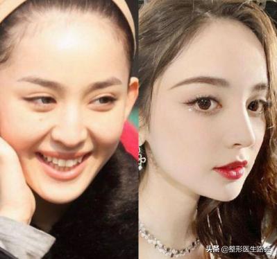 如何正确有效的缩小鼻翼,鼻翼大怎么缩小手术风险大吗