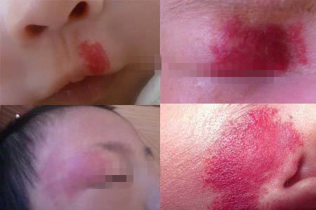 宝宝头上胎记,宝宝出生有青胎记