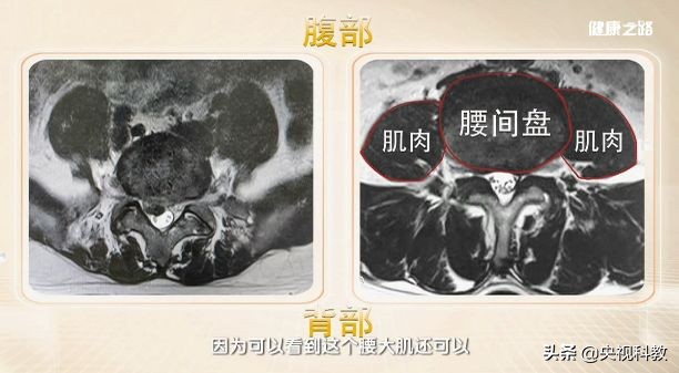 腰间盘突出怎么自我判定？怎么进行治疗？这篇文章告诉你