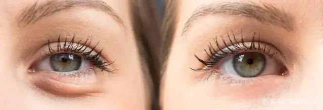 关于眼袋,眼袋的形成原因