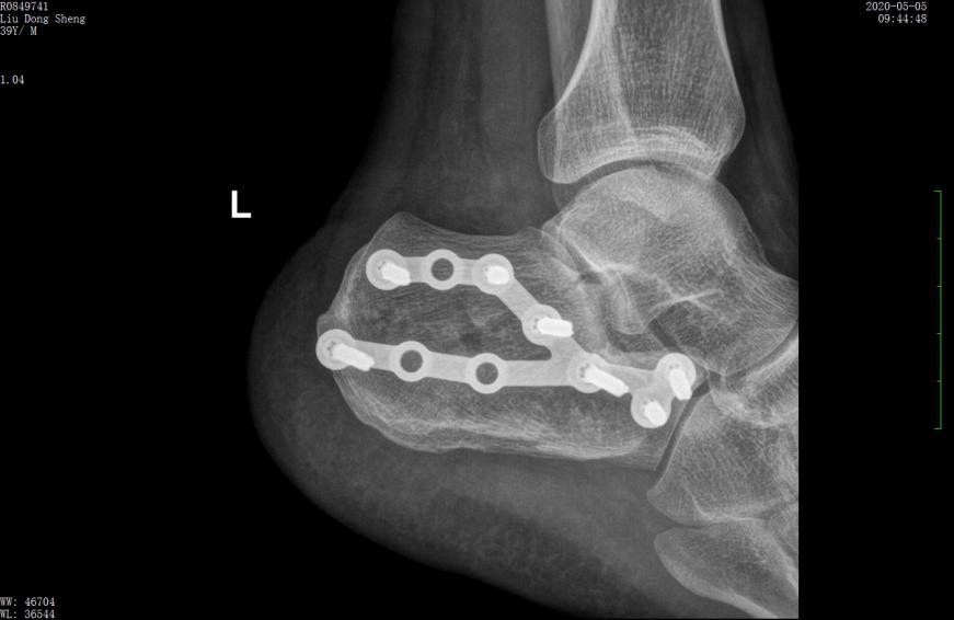 左股骨粗隆间粉碎性骨折微创手术,跟骨粉碎性骨折微创手术最快多久
