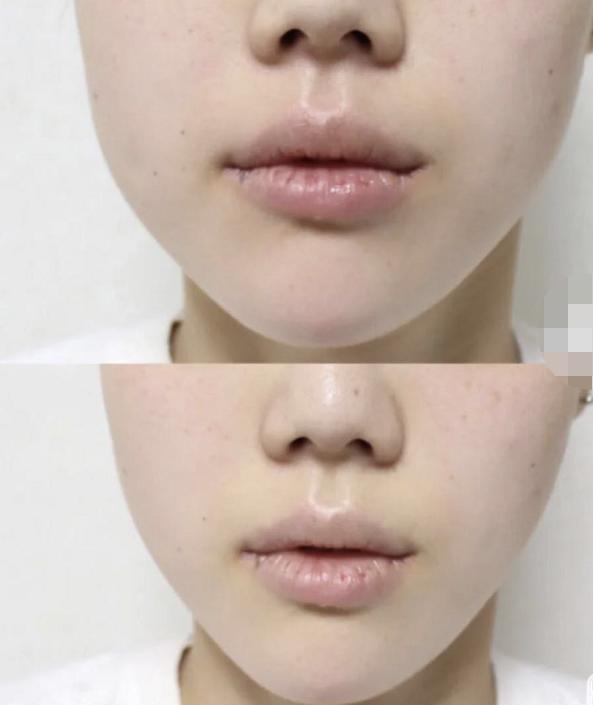 美容面部紧致提拉全过程,怎么做面部提拉改变大小脸