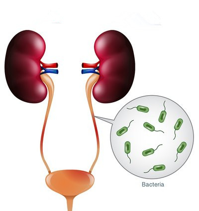 膀胱炎尿道炎反反复复怎么办,尿道炎引起的膀胱炎怎么治