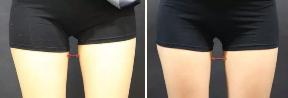 抽脂塑形央视新闻,央视提到减重代谢手术