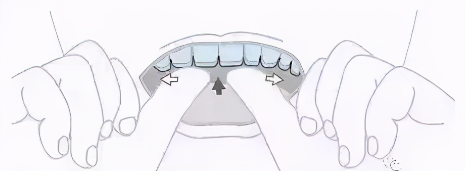 戴隐形牙套如何100分护理？