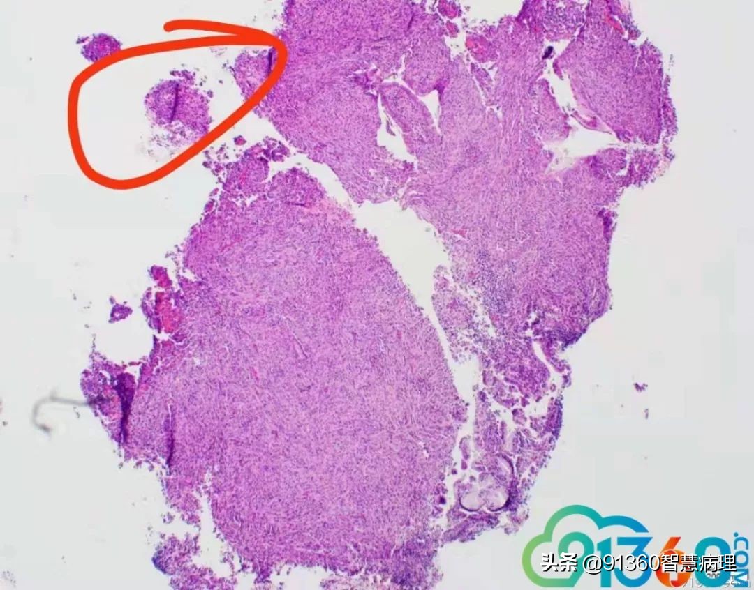 宫颈腺癌silvaa型用化疗吗,宫颈腺癌silvab型需要放疗几次