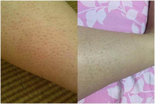 改善鸡皮肤身体乳果酸,果酸换肤改善鸡皮肤