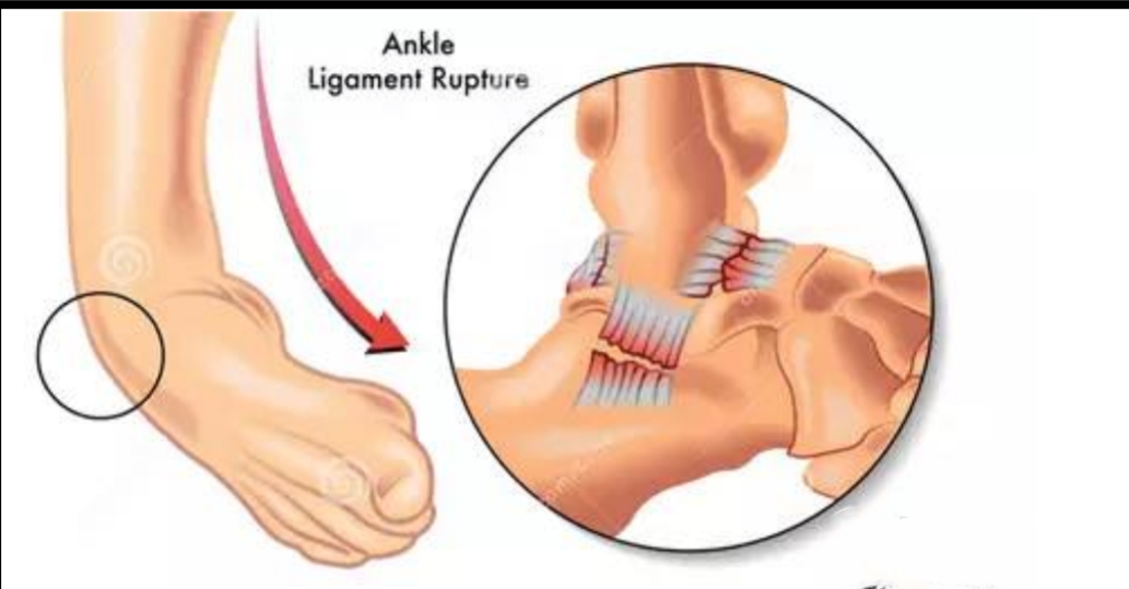 足踝扭伤疼痛位置图,踝足扭伤机制