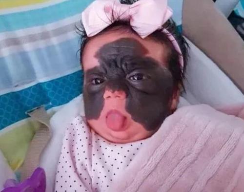 女童顶着“蝙蝠”形胎记出生，历经7次手术，如今过得怎样了